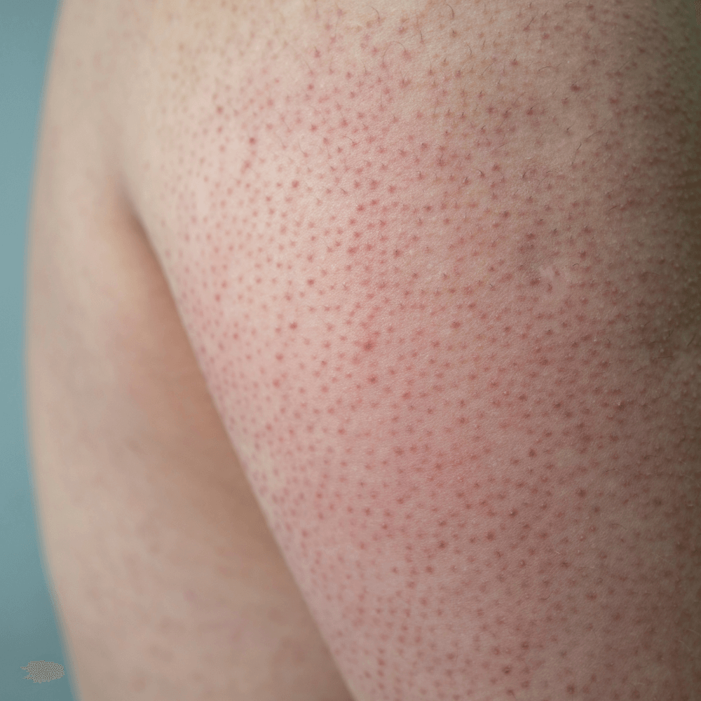 Libabőr és csirkeláb - a keratosis pilaris kezelése egyszerűen