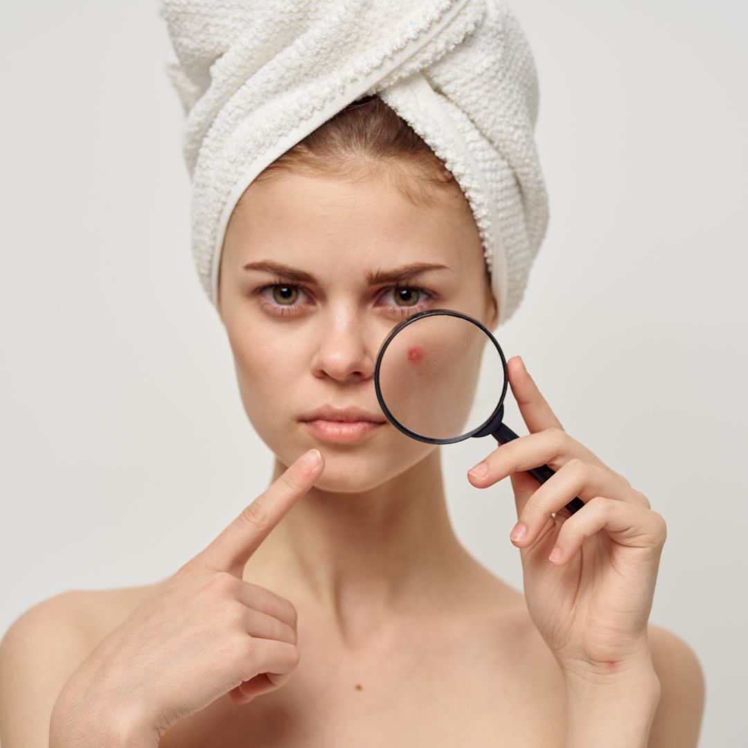 Akné felnőttkorban–gyulladás, mikrobiom és bőregyensúly az Eucerin DermoPure Clinical szemléletében