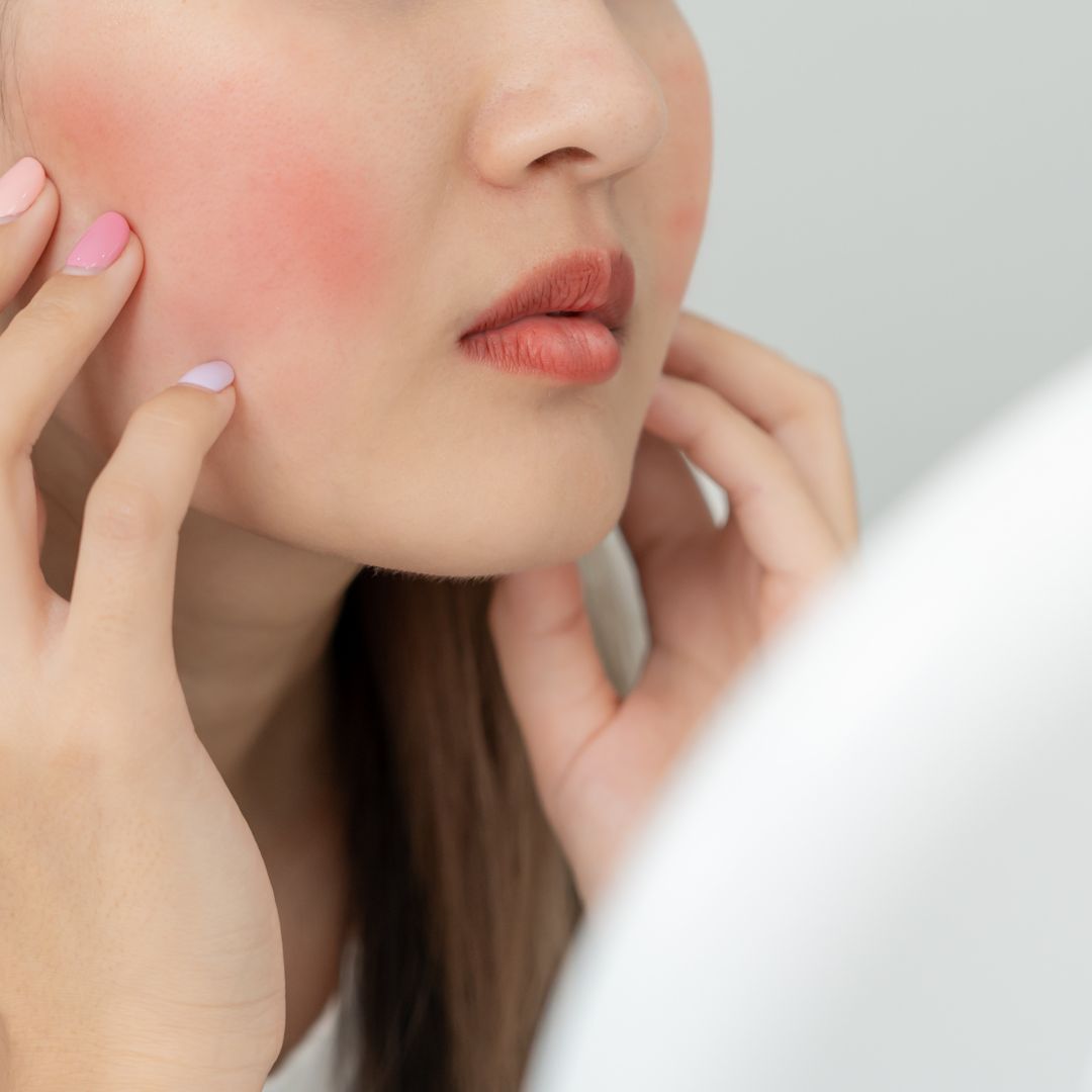 Rosacea ősszel: kiváltó tényezők és kímélő rutin